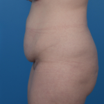 Extended Tummy Tuck Before & After Patient #6890