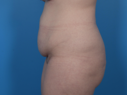 Extended Tummy Tuck Before & After Patient #6890
