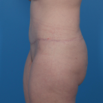 Extended Tummy Tuck Before & After Patient #6890