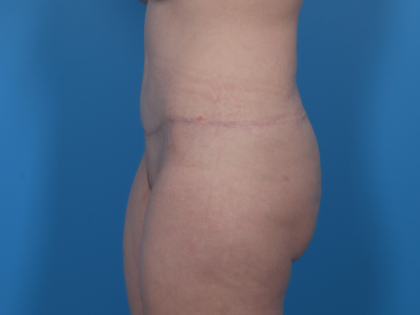 Extended Tummy Tuck Before & After Patient #6890