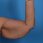 Arm Lift Before & After Patient #6942