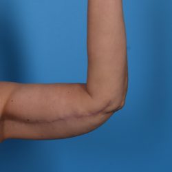 Arm Lift Before & After Patient #6942