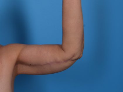 Arm Lift Before & After Patient #6942