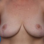 Mastopexy Before & After Patient #6941