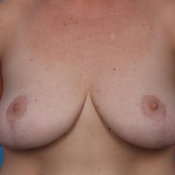 Mastopexy Before & After Patient #6941