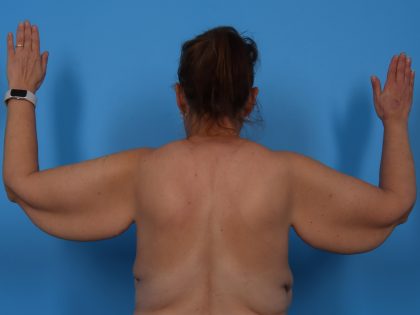 Arm Lift Before & After Patient #6942