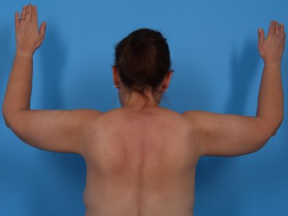 Arm Lift Before & After Patient #6942