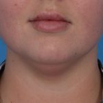 Neck Liposuction Before & After Patient #6955