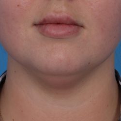Neck Liposuction Before & After Patient #6955
