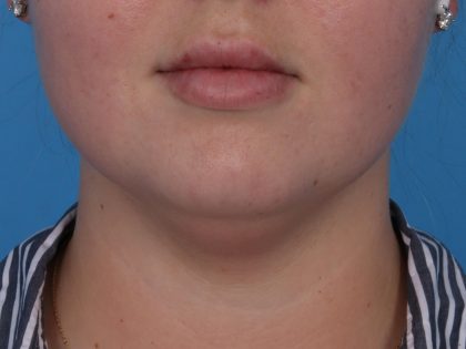Neck Liposuction Before & After Patient #6955