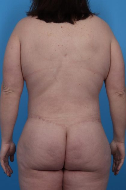 Lower Body Lift Before & After Patient #6963