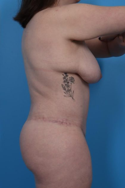 Lower Body Lift Before & After Patient #6963