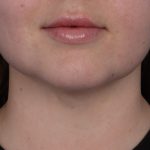 Neck Liposuction Before & After Patient #6955
