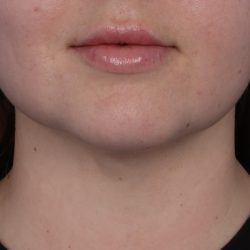 Neck Liposuction Before & After Patient #6955