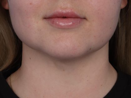 Neck Liposuction Before & After Patient #6955