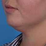 Neck Liposuction Before & After Patient #6955