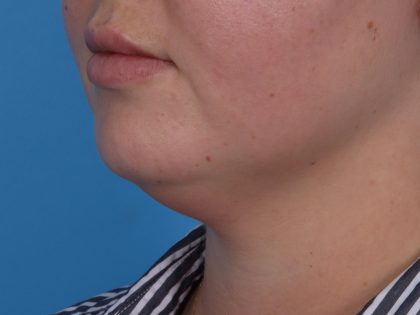 Neck Liposuction Before & After Patient #6955