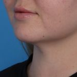 Neck Liposuction Before & After Patient #6955