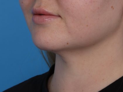 Neck Liposuction Before & After Patient #6955