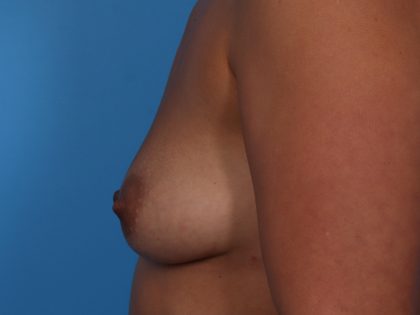 Breast Augmentation with Lift Before & After Patient #6962
