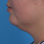 Neck Liposuction Before & After Patient #6955