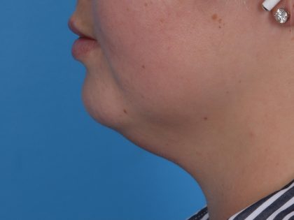 Neck Liposuction Before & After Patient #6955