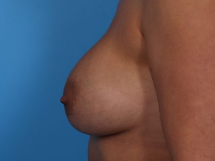 Breast Augmentation with Lift Before & After Patient #6962