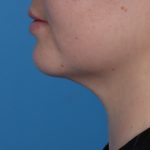 Neck Liposuction Before & After Patient #6955