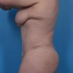 Lower Body Lift Before & After Patient #6963