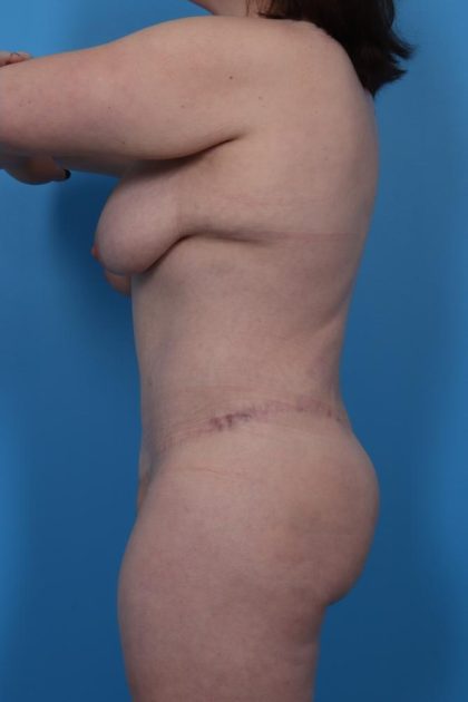 Lower Body Lift Before & After Patient #6963