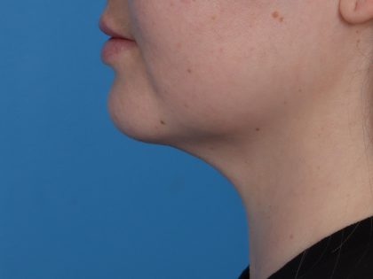 Neck Liposuction Before & After Patient #6955