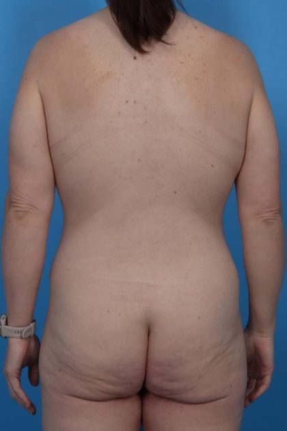Lower Body Lift Before & After Patient #6963