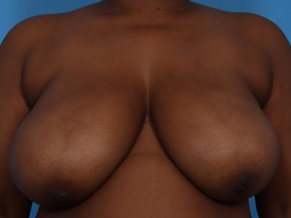 Mastopexy Before & After Patient #6989