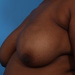 Mastopexy Before & After Patient #6989