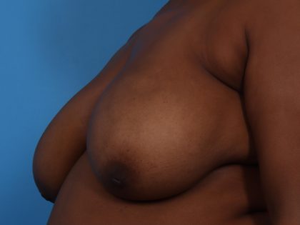 Mastopexy Before & After Patient #6989