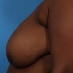 Mastopexy Before & After Patient #6989