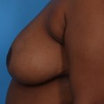Mastopexy Before & After Patient #6989