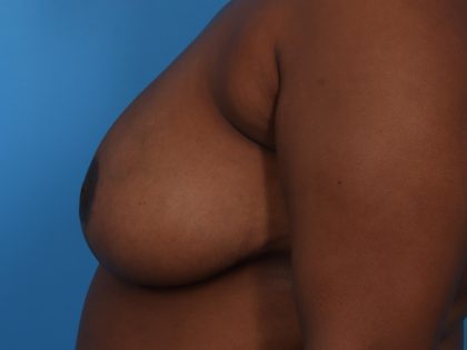 Mastopexy Before & After Patient #6989
